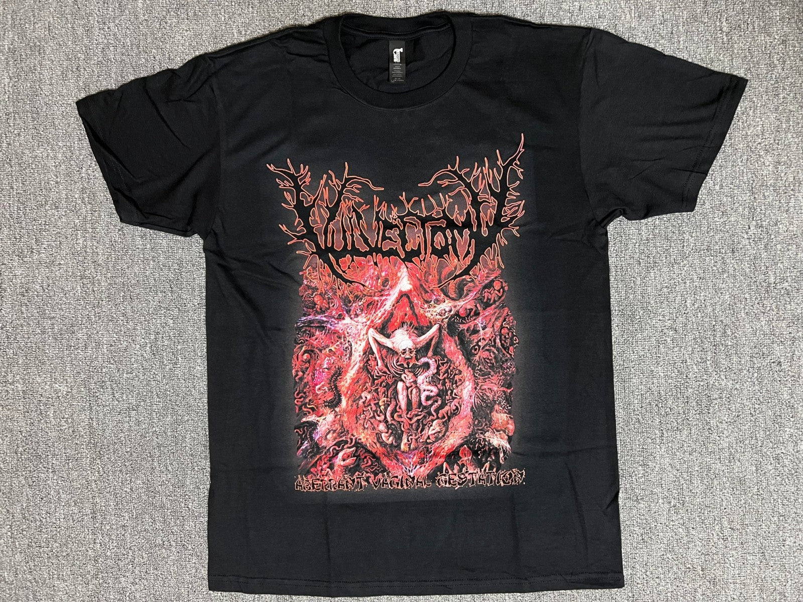 Vulvectomy - Aberrant Vaginal Gestation - T-Shirt