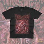 Vulvectomy - Aberrant Vaginal Gestation - T-Shirt